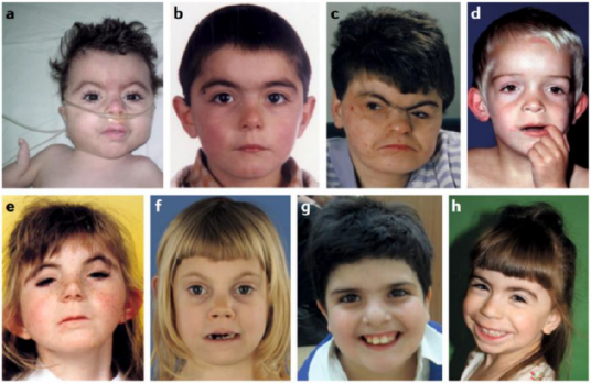 Figure 1 Facial phenotype of individuals with Cornelia de Lange Syndrome.