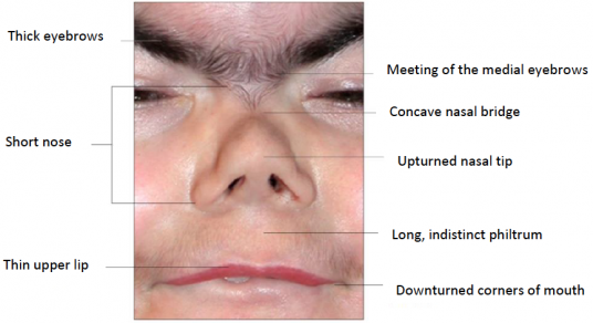 Figure 3 Cardinal facial features of Cornelia de Lange syndrome.